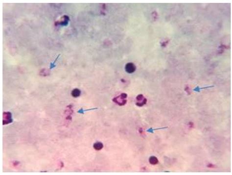 Microphotography P.vivax thick blood smear Parasite density of samples ...