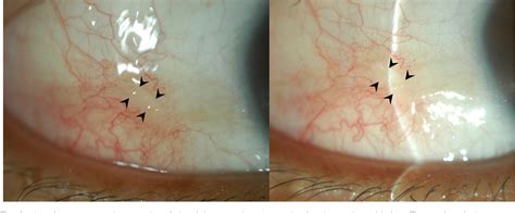 Removal of conjunctival cyst using argon laser photoablation. | Semantic Scholar