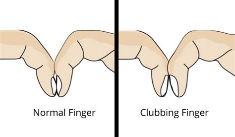 A simple finger trick to check if you've Lung Cancer : Physiosunit