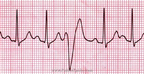 PVC ekg | They’re one of the most common forms of heart arrhythmia and ...