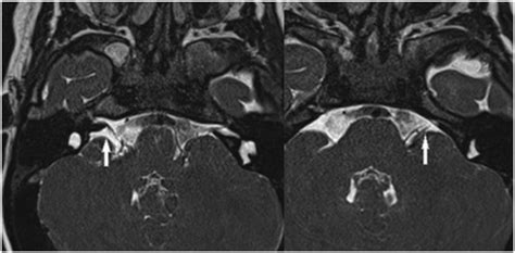 MRI transverse scan. (A) N.VIII on the right side. (B) N.VIII on the... | Download Scientific ...