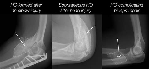 When Bone Grows Beyond the Elbow Skeleton: Heterotopic Ossification, Why Does it Matter and How ...