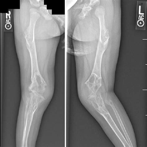 Lower extremity radiographs demonstrating acetabular dysplasia, coxa... | Download Scientific ...