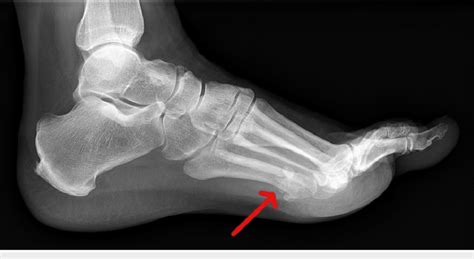 Lateral X-ray of the left foot The image shows well-corticated ossicles... | Download Scientific ...