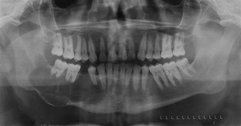 Odontogenic Keratocyst – Dr. G's Toothpix