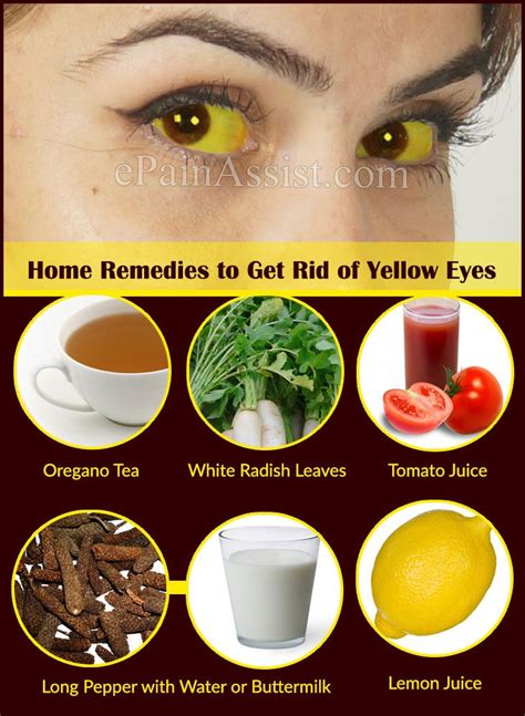 Home Remedies to Get Rid of Yellow Eyes | Yellow eyes, Home remedies, Remedies