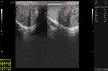 Seminoma | Radiology Case | Radiopaedia.org