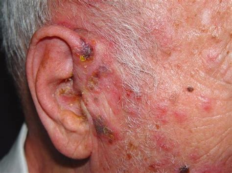 Herpes zoster (syn. shingles)