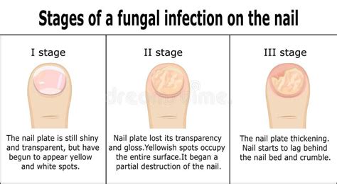 Stages of a Fungal Infection on the Nail Stock Vector - Illustration of ...