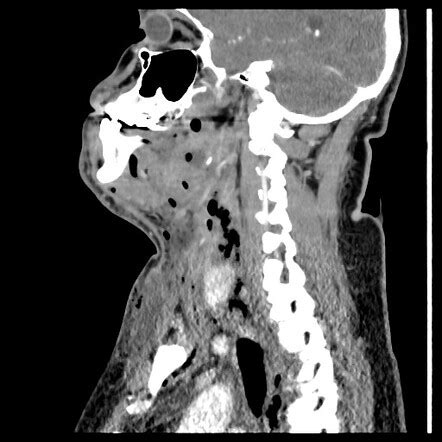 Ludwigs Angina Radiology