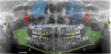 Oral And Maxillofacial Radiolo [IMAGE] | EurekAlert! Science News Releases