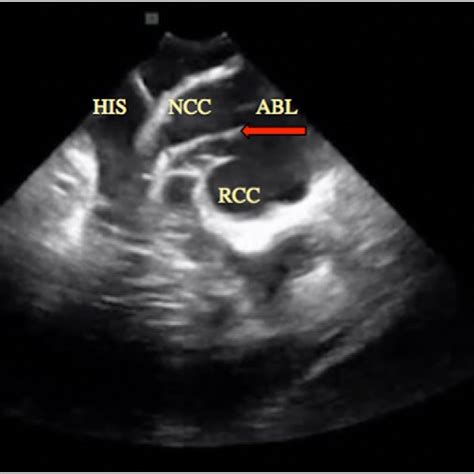 ICE image of PVC ablation. The PVC origin is from the anterolateral ...