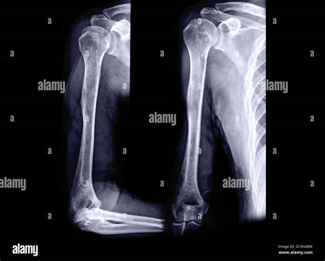 Distal Humerus Axial View