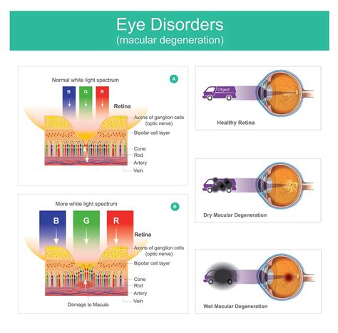 Macular Degeneration Infographic | Fort Lauderdale Eye Institute