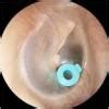 7 Undesirable Ear Tube Complications (which may require more surgery!) - Momma Addict