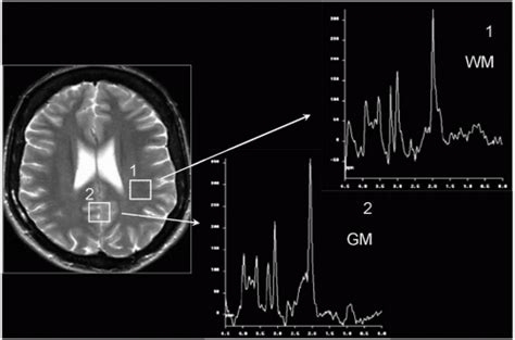 MRI BRAIN WITH SPECTROSCOPY – ScanLab Center