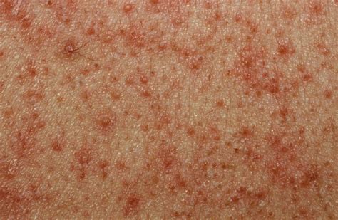 Keratosis Pilaris - Causes, Symptoms, How To Get Rid of It