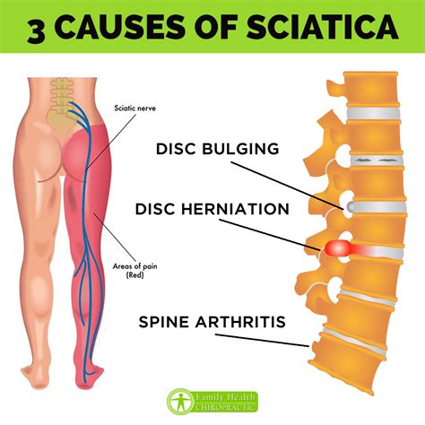 Austin Chiropractor | Sciatica Treatment in Austin Texas