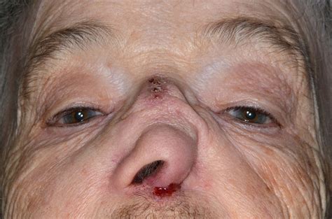 ‘Saddle nose’ deformity caused by advanced squamous cell carcinoma of the nasal septum | BMJ ...