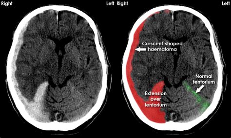 CT brain image gallery - SDH - extension