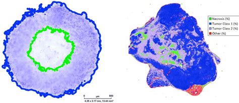 Tumor anatomy in spheroid models and human tumors. (A) Tumor spheroid ...