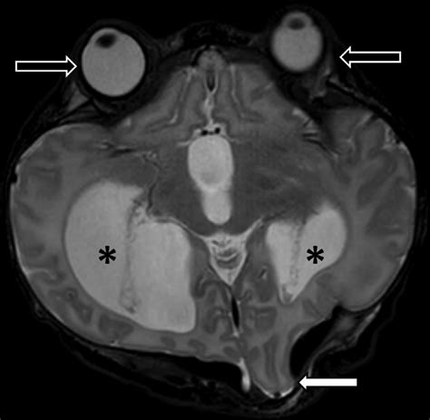 -Axial T2-weighted MRI of the brain demonstrates extension of the left ...