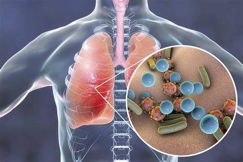 Evaluasi Kuantitatif Penggunaan Antibiotika pada Pasien Pneumonia-ICU dengan menggunakan metode ...