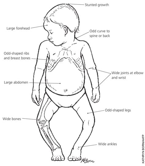 Rickets: What It Is and How It’s Treated | AAFP