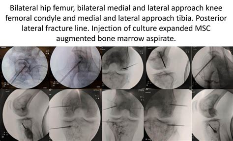 avascular necrosis treatment without surgery