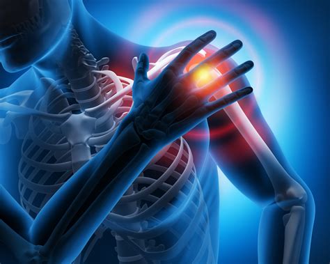 Calcific Tendonitis - Shoulder Pain Relief