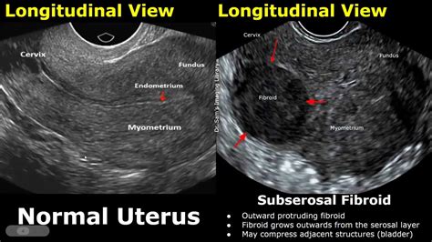 Uterus Fibroid Ultrasound