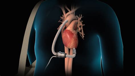 Left Ventricular Assist Device | LVAD | Nucleus Health - YouTube