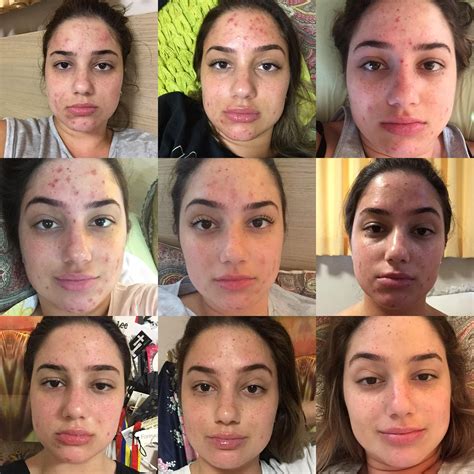 [B&A] My 6 month Roaccutane Journey. | Roaccutane, Skin therapy, Skin