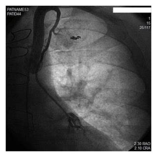 Patent hypoplastic LIMA with large thoracic side branch. | Download Scientific Diagram