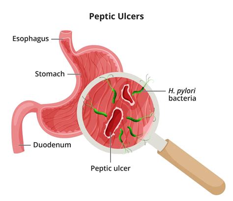 Definition & Facts for Peptic Ulcers (Stomach or Duodenal Ulcers) - NIDDK