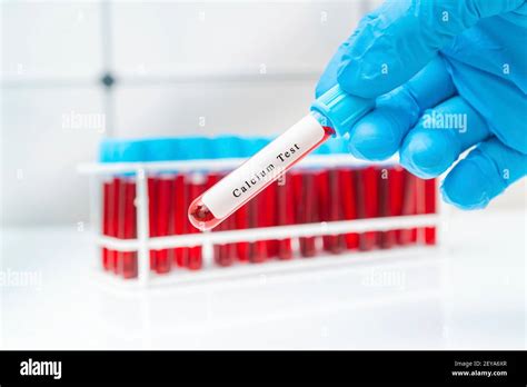 Calcium blood test, conceptual image Stock Photo - Alamy