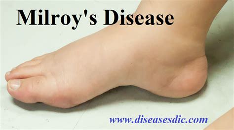 Myotonic dystrophy: causes, treatment and prevention.