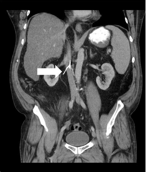 Perforation of Inferior Vena Cava by Inferior Vena Cava Filter - The Western Journal of ...