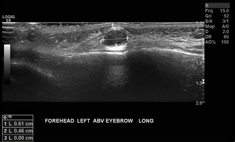 Epidermoid Cyst Ultrasound