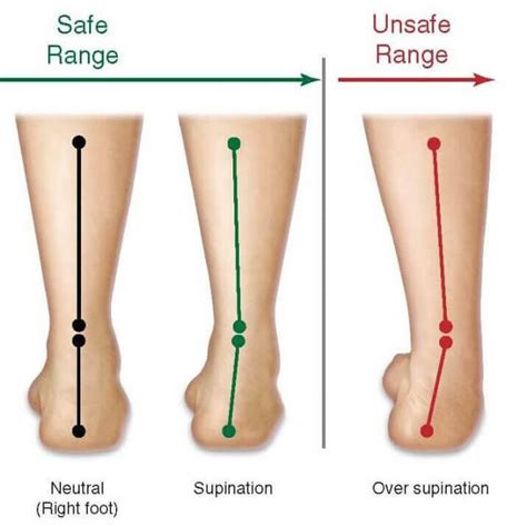 Underpronation, Supinated and High Arched Foot