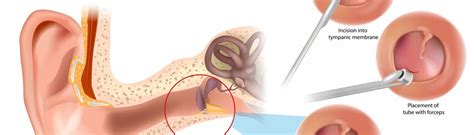 Ear Tube Surgery for Adults | North Carolina Specialty Hospital