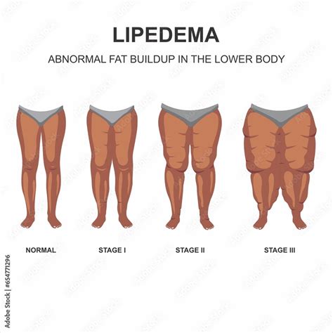 Lipedema stages and symptoms illustration Stock Illustration | Adobe Stock