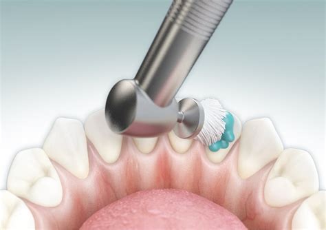 #1 Prep Course for DANB's Coronal Polishing Exam [TRY FREE]