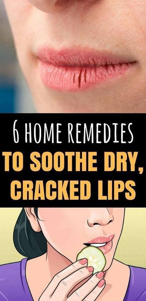 6 Home Remedies To Soothe Dry & Cracked Lips | Dry cracked lips, Dry ...