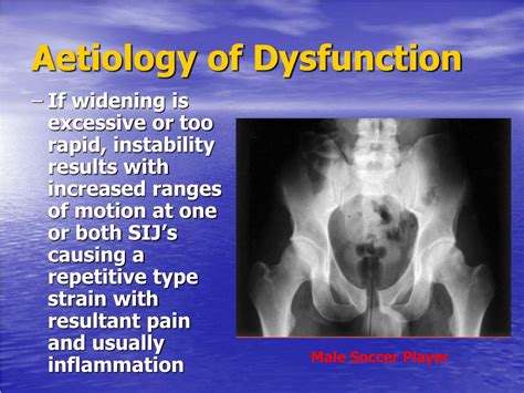 PPT - SYMPHYSIS PUBIS DYSFUNCTION PowerPoint Presentation, free ...