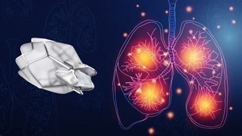 Pros And Cons Of The Zephyr Valve Procedure - Lung Institute