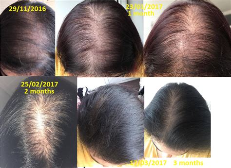 Biotin Before And After One Month - Brain Mind Article