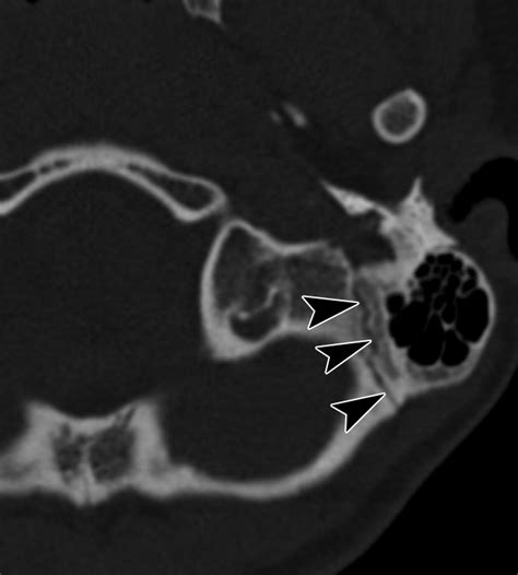 Fracture Mimics on Temporal Bone CT: A Guide for the Radiologist | AJR