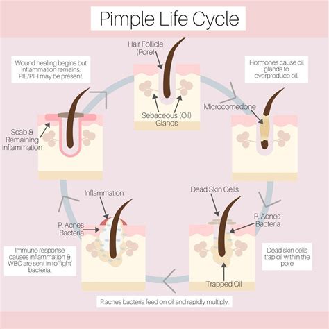 Pimple Life Cycle Canva Template | Dermatoloji