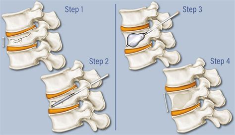 Should You Have Kyphoplasty to Treat a Spinal Fracture?